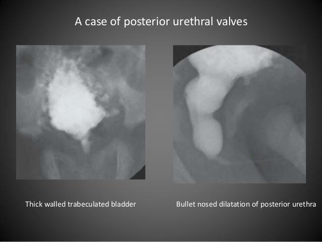 Voiding cystourethrography (VCUG) is necessary to confirm the diagnosis and to assess