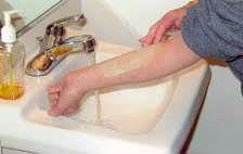 Kanülasyon İşlem Basamakları Hastaya işlem öncesi kolunu yıkaması öğretilir, Kullanıcı da ellerini yıkar ve eldiven giyer, Damar yolu