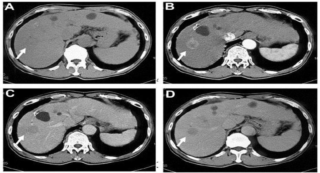 HCC de BT Görüntüleme Trifazik görüntüleme Arteryel (30.