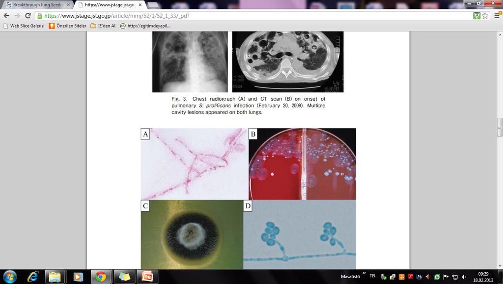 Scedosporium Hematolojik malignensi ve solid organ alıcılarında bildirilmiş Mortalite yüksek, S.