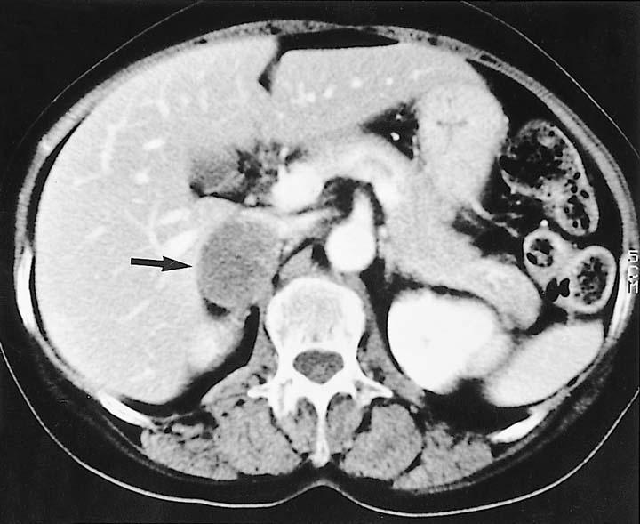 adrenal met KHDAK % 30 (otopsi) AC