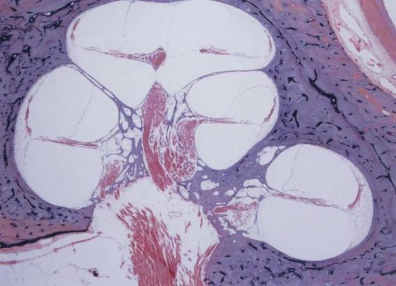 Şekil 1. Endolenfatik hidrops. Meniere hastalığı tanılı olgunun temporal kemik koklea incelemesinde skala mediadaki genişleme görülmektedir.