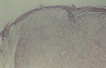 P nar E ve ark. ponentlerin kar fl m ndan oluflan bu neoplazi ilk defa Virchow taraf ndan tan mlanm flt r. Tümörün histogenezinde üç teori öne sürülmektedir.