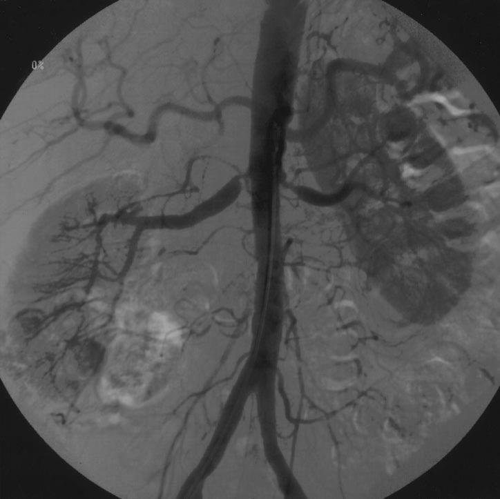 Aterosklerotik (90%) Fibromuskuler displazi (10%) Medial fibroplazi (90%) Klasik