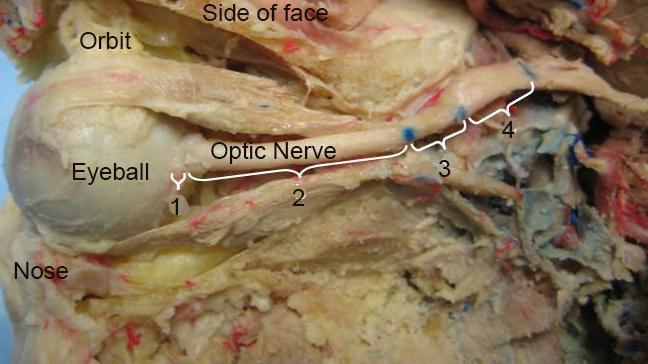 Şekil 3a. N.opticus Görme Yolu ile ilgili Klinik bilgiler: Sirkumferensiyal anopia: N.opticus un kanalında sıkışması ile olur. Santral skotom: Optik nörit ya da retrobulbar nörit sonucu olur.