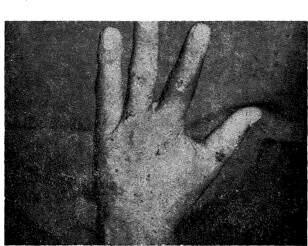 Şekil 17 : Üçüncü parmağın bime parmağın yerine transpoze edilmesinin şekilsel görünümü.
