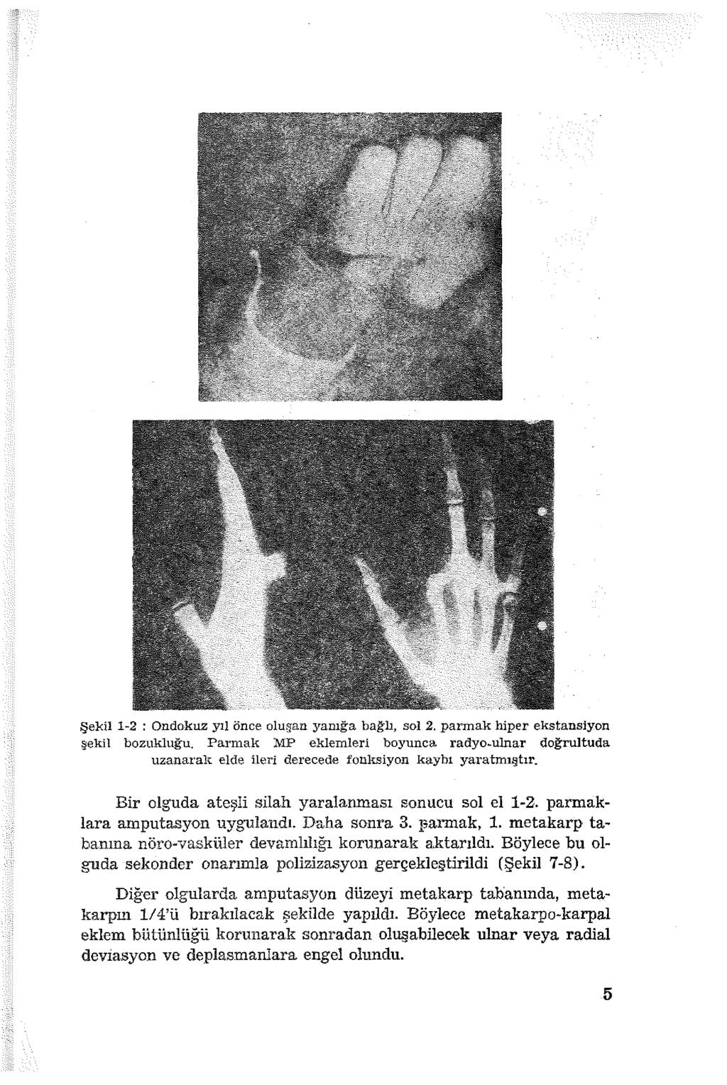Şekil 1-2 : Ondokuz yıl Önce oluşan yanığa bağlı, sol 2. parmak hiper ekstansıyon şekil bozukluğu.