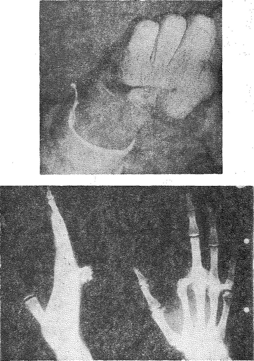 parmaklara amputasyon uygulandı. Daha sonra 3. parmak, 1. metakarp tabanına nöro-vasküler devamlılığı korunarak aktarıldı.