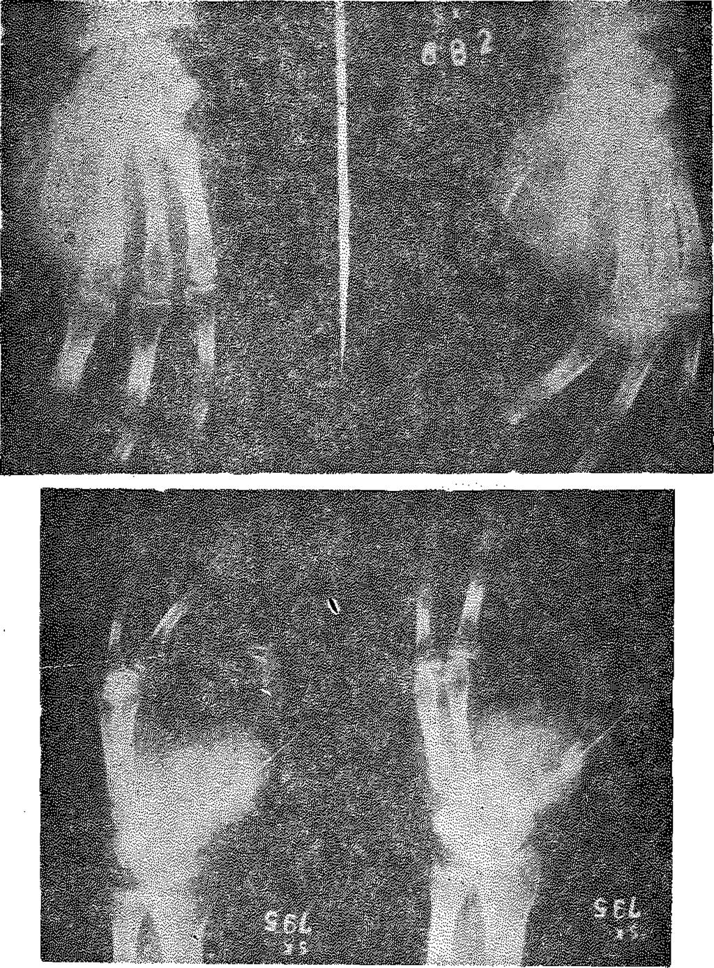 İşaret Parmağı Metakarpal Amputasyonu: Bütün olgularda anastezi olarak, bilek düzeyinde median, ulnar ve radial sinirlere uygulanan bölgesel blokaj yapıldı.
