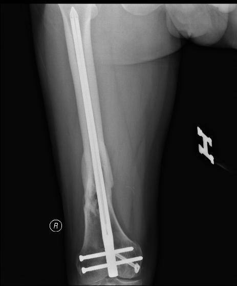26 yaş erkek, bilateral femur ve patella fraktürü ile sol medial malleol ve sol