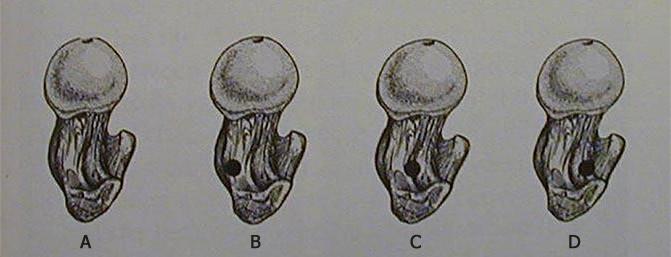 31 Şekil 13. Antegrad femur intramedüller çivide A. trokanter ve boyun anatomisi B. anterior giriş C. optimum giriş D.