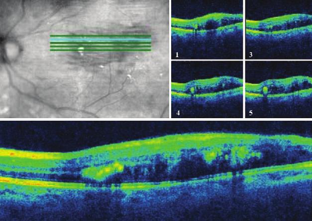 Fundus floresein anjiografide sağ gözde mikroanevrizmalar, diyabetik makula ödemi ve lezyona uyan bölgede geç safhada seröz retina dekolmanına bağlı göllenme nedeni ile hiperfloresans (Resim 5); sol