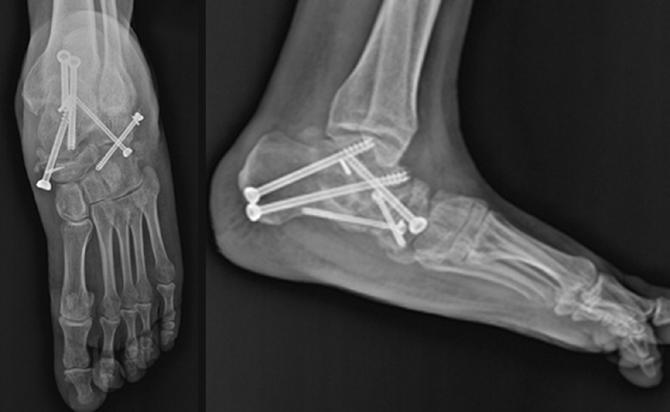Aksesuvar naviküler kemik üç şekilde görülür: Tip I: Aksesuvar kemik, posterior tibial tendon içinde sesamoid halde yer alır.