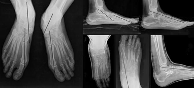Pes planovalgus 425 Şekil 20. Sol tibialis posterior tendon yetmezliği olan hastanın ameliyat öncesi, kalkaneal uzatma, FDC transferi ve PTT plikasyonu sonrası radyolojik görünümleri.