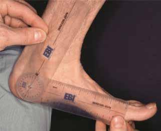 416 TOTBİD Dergisi Şekil 6. Parmak ucu yürümede topuktaki valgus deformitesi düzeliyorsa deformite esnektir. FİZİK MUAYENE Çocuğun muayenesi inspeksiyonla başlar.
