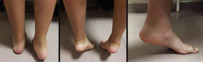 Çocuk ayağını yere bastığı zaman mediyal longitudinal arkın çöktüğü görülür. Topuklar mutlaka incelenmelidir ve valgus deformitesi olup olmadığı kayıt altına alınmalıdır.