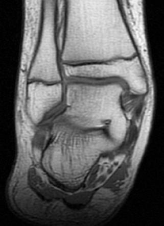 lezyonu Romatoid artrit Plantar fasya rüptürü Obezite Şekil 13. Manyetik rezonans görüntüleme, çok nadiren tarsal koalisyon amacıyla kullanılabilir.