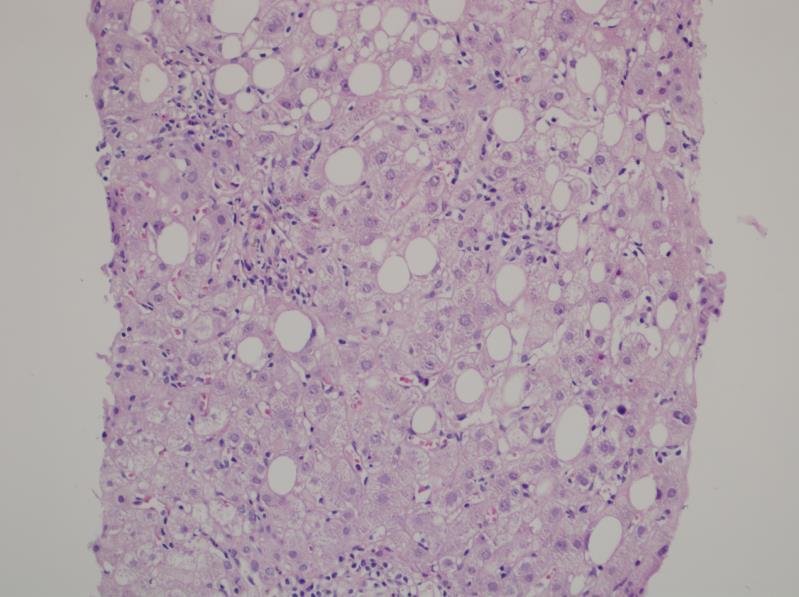 HCV Steatoz Makro-mikroveziküler mikst şekilde ve hafif derecelerdir. Zonal dağılım göstermez. Direkt viral etkiye, muhtemelen HCV core proteine bağlıdır. * Özellikle genotip 3 de görülür.