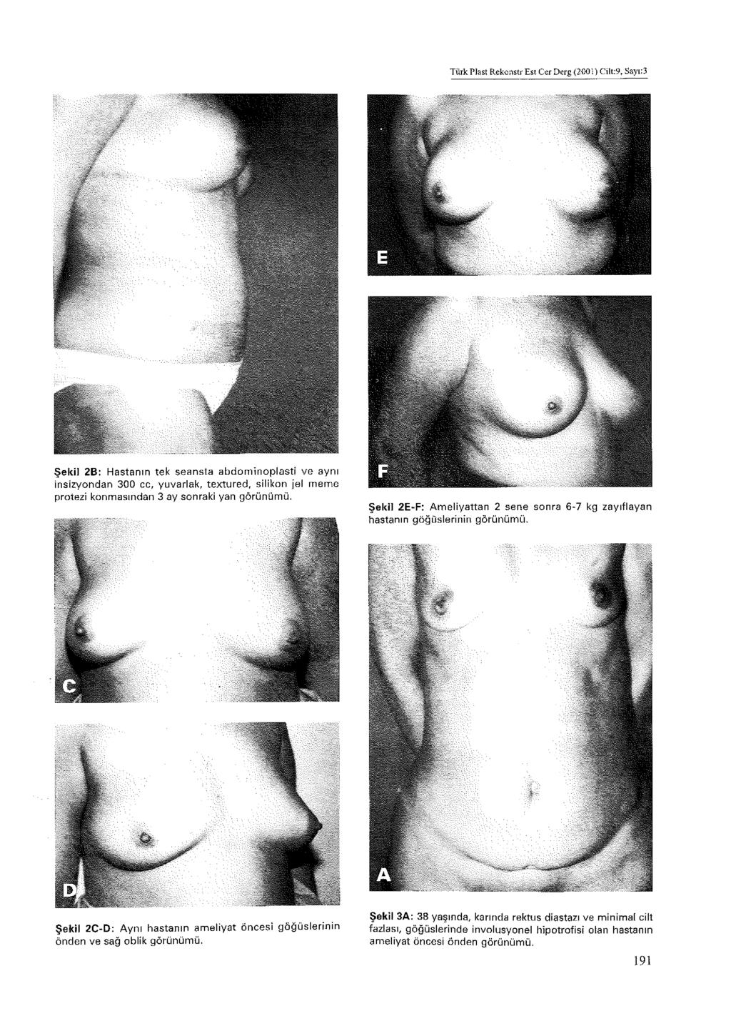 Türk Plast Rekonstr Est Cer Derg (2001) Cilt:9, Sayı;3 Şekil 2C-D: Aynı