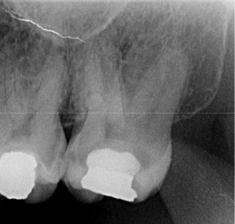 Uslu et al. azı dişlerinde görülen iki adet palatinal kökün varlığı nadir görülen bir anomali olarak değerlendirilmektedir. 3-6 Libfeld ve Rotstein in, 1.
