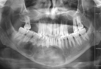 Panoramik grafide mandibuler sol kaninden sağ ikinci molar dişe kadar devam eden ve bu bölgedeki tüm dişleri içine alan, geniş radyolüsent görüntü veren, multiloküler, sınırları belirgin, basis