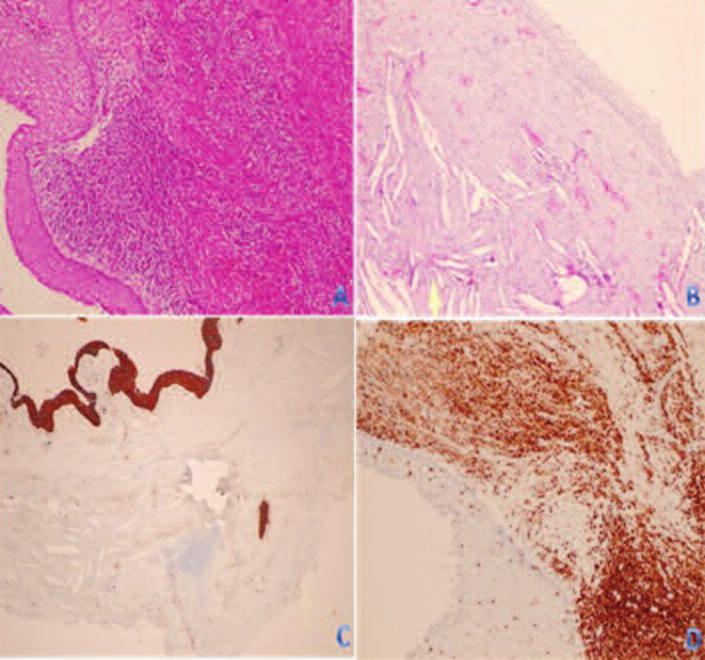 A B C D RESİM 5: a) Çok katlı epitel altında ve stromada belirgin polimorf hücreli lökosit ve lenfositlerden zengin inflamatuar hücre infiltrasayonu izlenmektedir (H&Ex10); b) Çok katlı yassı epitel