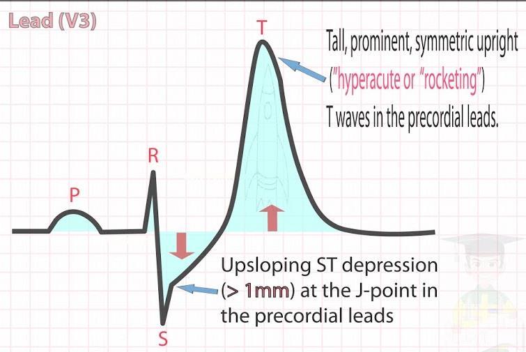 de Winter T dalgaları Prekordiyal derivasyonlarda yüksek, çıkıntılı, simetrik T dalgaları. Prekordiyal derivasyonlarda J noktasında >1 mm yukarı eğimli ST segment depresyonu.