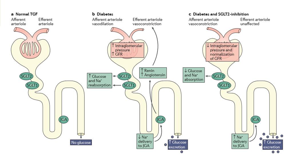 SGLT-2 İnhibisyonu ve Olası Nefroprotektif Mekanizmaları Proksimal tübülde azalan glukoz ve Na reabsorbsiyonu TGF mekanizması ile intra-glomerüler basıncı azaltır Proksimal tübül hücrelerindeki