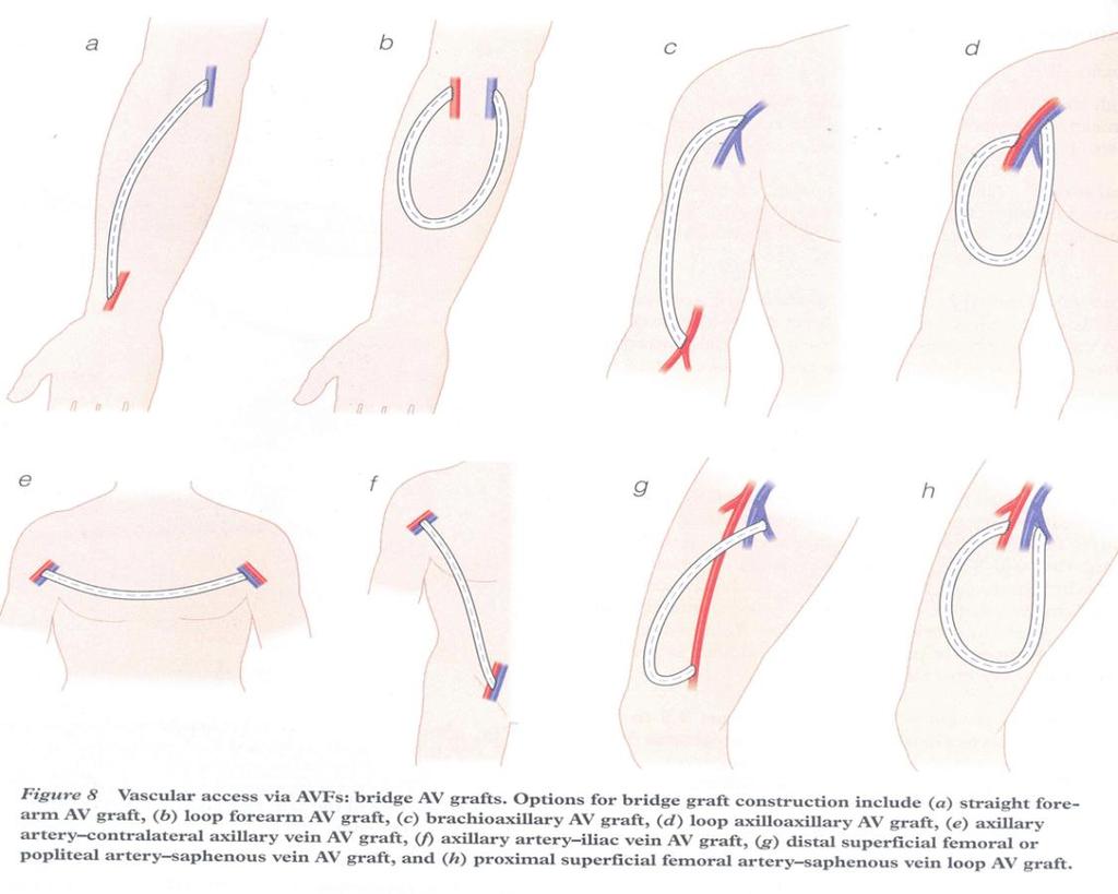 Tünelli kateterlerden daha üstündür A-V Graft A-V fistüle