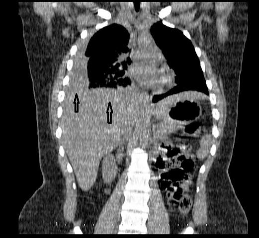 Şekil 2 : Preoperatif bilgisayarlı akciğer tomografisi koronal kesitte: sağ hemidiyafragma net izlenmemektedir Hastaya sağ hemitoraksa kapalı su altı drenajı uygulandı.