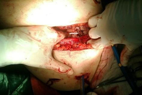 Genel anestezi altında sol lateral dekübit pozisyonunda 7. interkostal aralıktan posterolateral torakotomi ile toraksa girildi.