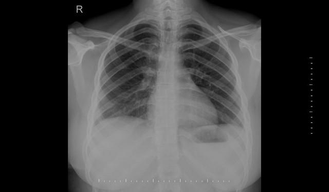 Şekil 4 : Postoperatif 1 ay sonra kontrol akciğer grafisi Tartışma ve Sonuç Diyafragma rüptürlerine, genellikle künt ve penetran travmalardan sonra rastlanmaktadır.