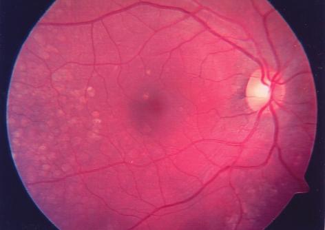 68 Membranoproliferatif Glomerulonefrit Tip II ye Baðlý Fundus Bulgularýnýn Optik Koherens Tomografi ile Deðerlendirilmesi Membranoproliferatif glomerülonefrit (MPGN), hematüri ve proteinüri ile