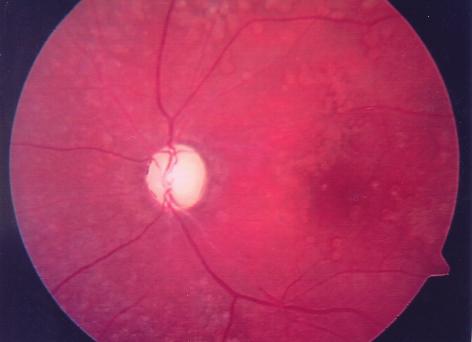 Ret - Vit 2003; 11 : 67-71 69 Resim 2 : Sol gözde optik atrofi, alt temporal arterde skleroz ve drusen benzeri lezyonlar nadir görülen fakat klinik bulgularý iyi tanýmlanmýþ bir hastalýktýr.