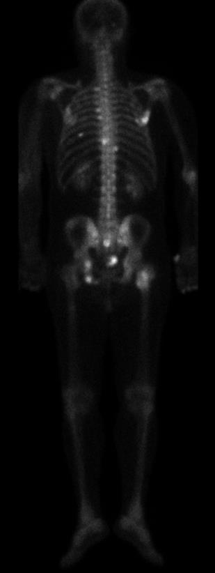 KEMİK SİNTİGRAFİSİ Sağ parietal kemikte, manibrium sternide, sağ