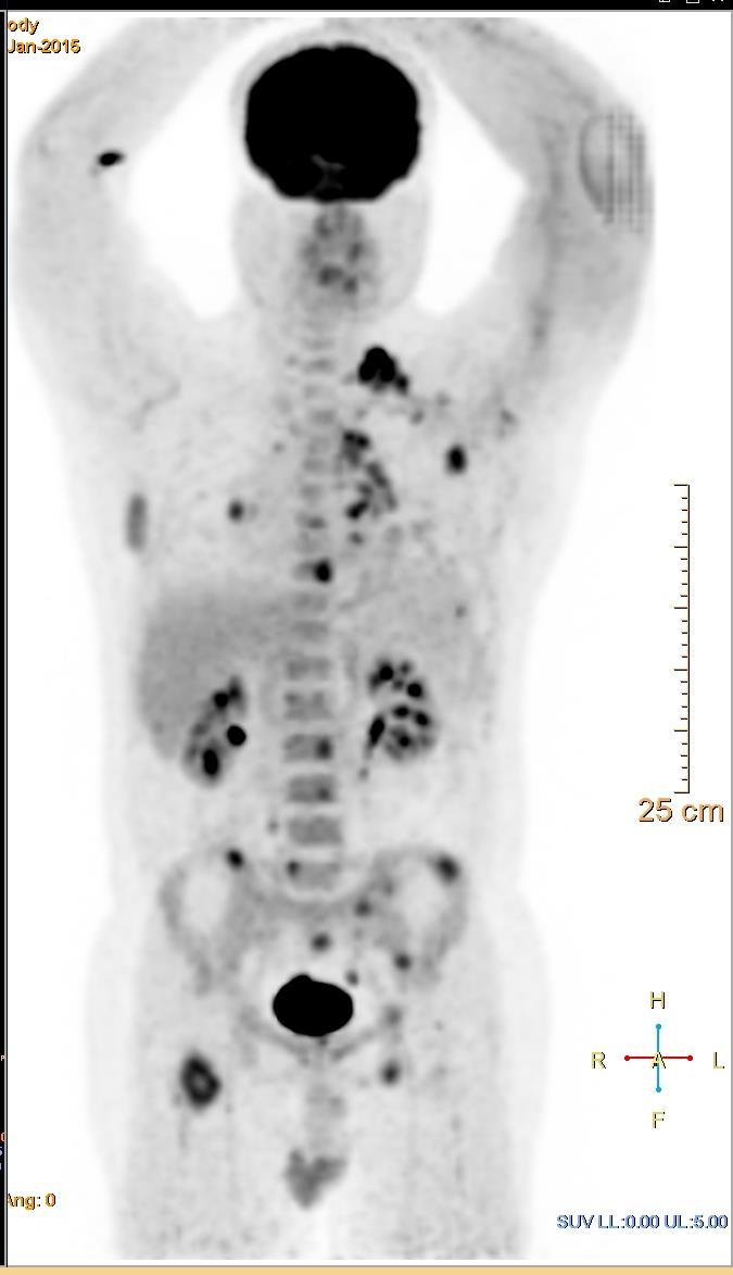 PET-CT