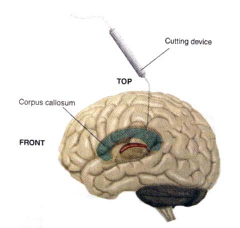 Ayrık-Beyinler (Split Brains) Sözel davranışla ilgili beyin alanları bilinçten sorumlu yapıları içeriyor olabilir.