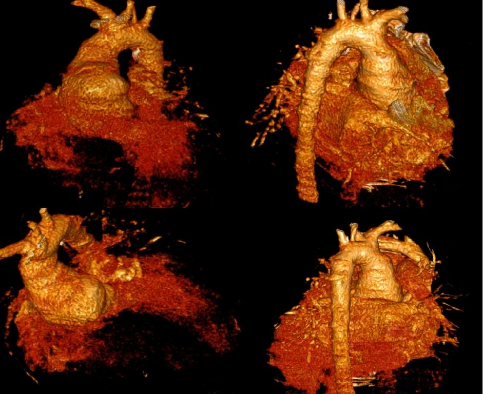 Olgu Sunumu Sekiz yaşında kız hasta, daha önceden 8 günlükken kliniğimizde BAT, atrial septal defekt (ASD), ve patent duktus arteriozus (PDA) tanıları nedeni ile Jatene operasyonu, ASD kapatılması ve