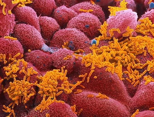 H. influenzae Sadece insanda bulunur Solunum yolları flora üyesidir (Sağlıklı insanların %30unda) Hastalık 6ay - 5 yaş çocuklarda ve immün sistemi zayıf