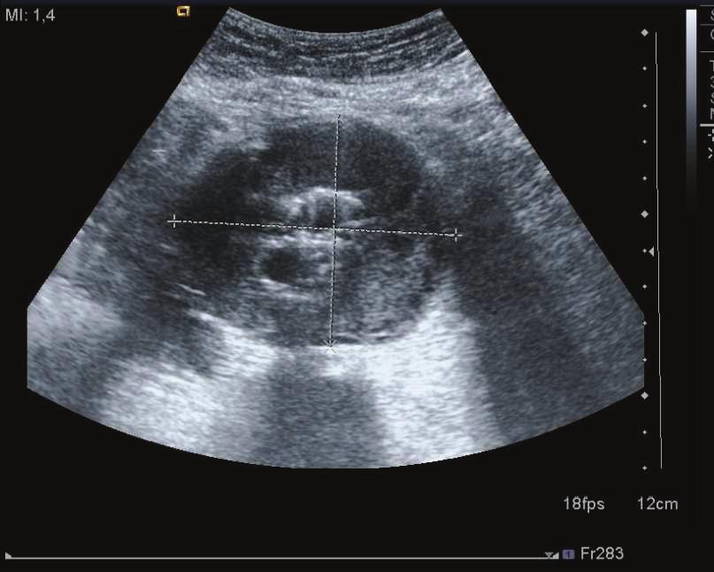 DOPPLER US TEKN Tüm hastalara supin pozisyonda, nefes tutturularak ya da nefes tutamayan hastalarda yüzeyel solunum sırasında abdominal aorta ve dallarına yönelik Doppler US tetkiki yapıldı.