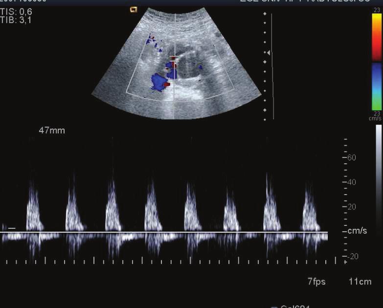 Resim 11, 12: Aksiyel BTA görüntülerde anevrizma içerisinde stent ve stentin orta