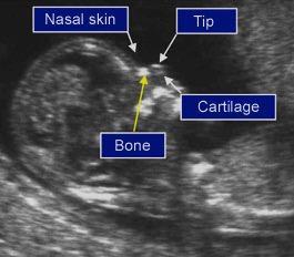 Fetal burun kemiğinin incelenmesinde gebelik 11 +0-13 +6 haftada ve CRL 45-84 mm arasında olmalıdır Görüntü fetal baş ve göğüs