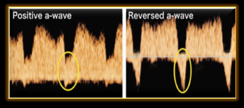 0 mm) olmalı ve sarımsı aliasing alanına yerleştirilmelidir İnsonasyon açısı 30 dereceden az olmalıdır Tüm dalga formunu