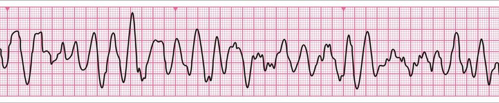 Şok uygulanan (VF) Düzensiz dalga formu QRS kompleksi yoktur Frekans ve amplitüdü değişken