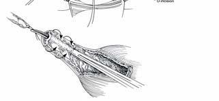 ::1-Üreterovezikostomi,2-Psoas hitch, Üreter yaralanma sonucu tamamen kullanılmaz