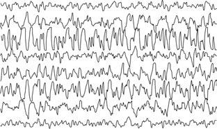 Yaman ve ark. Nonkonvulsiv status epileptikuslu dört olgu sunumu 163 Hz frekansl yavafl dalgalardan kurulu bir aktivite izlendi (fiekil 3a).