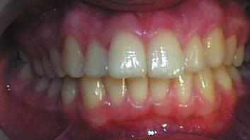 022, paslanmaz çelik ark telleri alt ve üst dental arklara yerleştirildi. Tedavinin 5. ayında, ite-fixer apareyi yerleştirildi (Resim 2a-c).