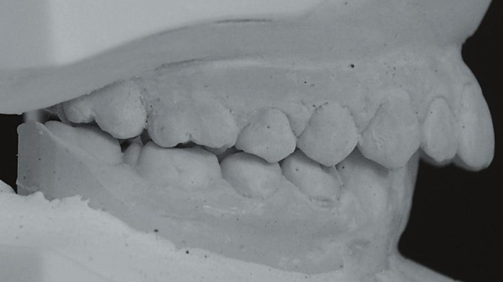 molarlarda distalizasyon ve üst kesicilerde dikleşme elde edildi. yrıca, o-gn mesafesinde 5 mm.