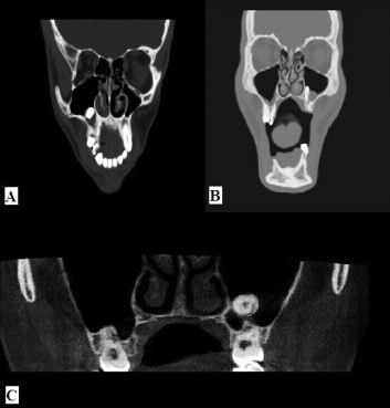 lişim ektopik diş gelişimine ve erüpsiyonuna neden olabilmektedir. 1,2 Ektopik erüpsiyon dental yapılar içerisinde sıklıkla görülürken, farklı bölgelere olan ektopik erüpsiyon ise nadirdir.