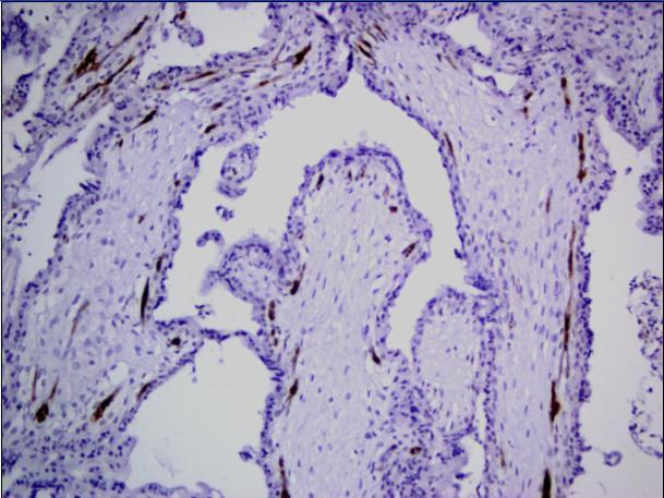 Şekil 17. İstenmeyen gebelik (kontrol grubu) olgusunda villus damar sayısı göreceli olarak azdır. (CD31 antikoru, immunperoksidaz, 200 x) Şekil 18.